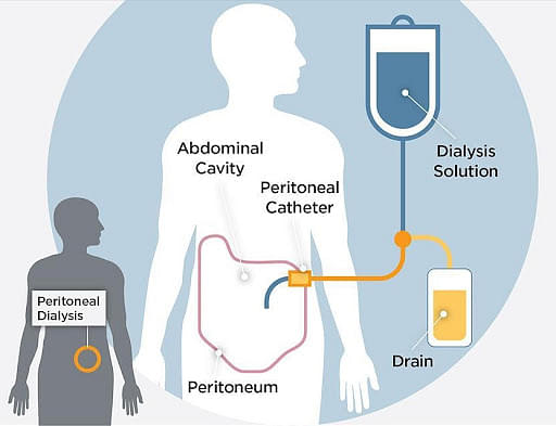 Peritoneal Dialysis Principles Procedure Advantages 7250